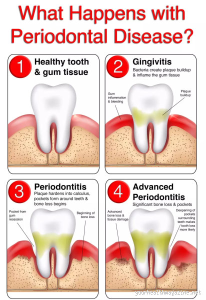 Can I Treat Periodontitis on My Own? Understanding the Risks and Solutions