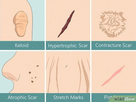 Can Scar Tissue Be Broken Down? Here's What You Need to Know