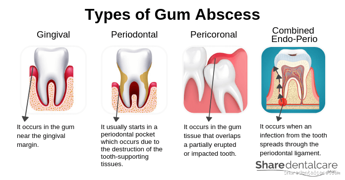 Is a Gum Abscess Hard or Soft? What You Need to Know