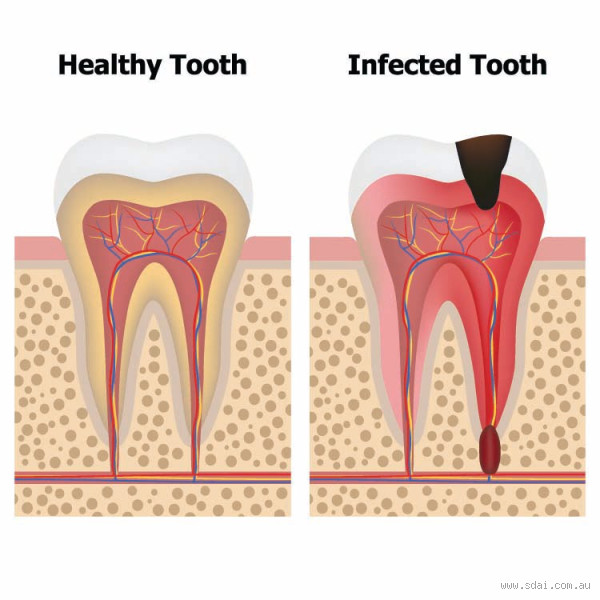 Will an Infected Tooth Eventually Stop Hurting? Here’s What You Need to Know