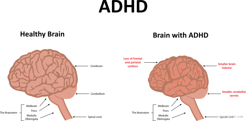 Are People Born with ADHD or Does It Develop Over Time?