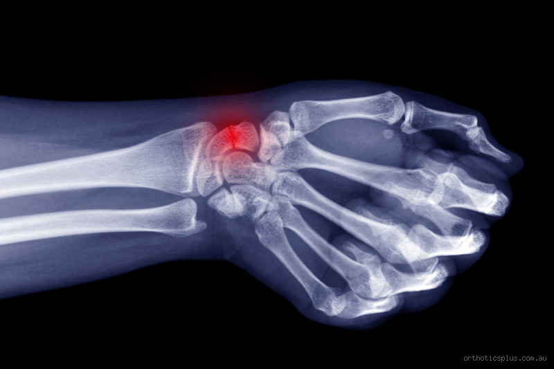Can a Broken Wrist Go Back to Normal? What You Need to Know