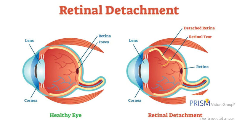 Can a Detached Retina Heal Naturally? What You Need to Know