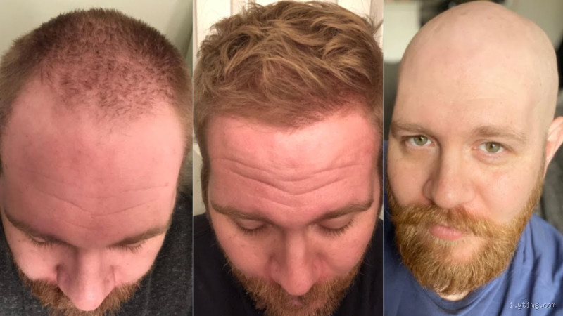 Can Baldness Be Reversed? The Truth Behind Hair Loss Solutions