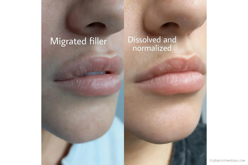 Can Filler Migrate After a Year? Here's What You Need to Know