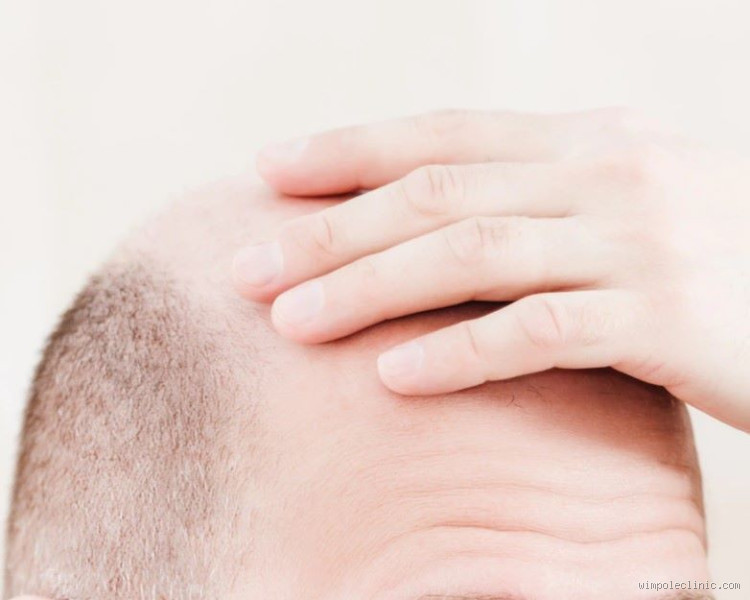 Can I Go Bald If My Dad Isn’t: Understanding the Genetics of Male Pattern Baldness?