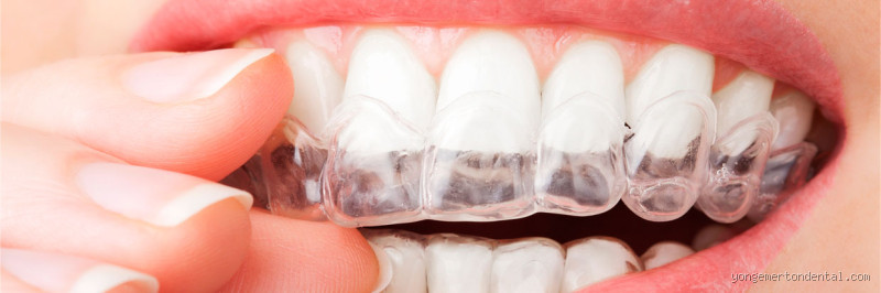 Can Invisalign Double as a Night Guard? The Truth You Need to Know!