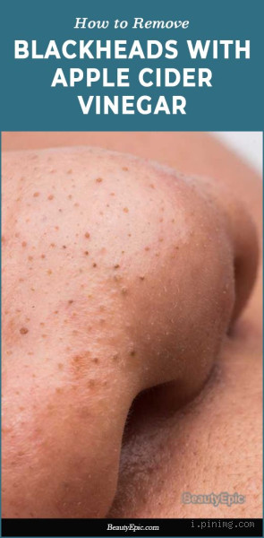 Can Vinegar Get Rid of Blackheads? Here's What You Need to Know!