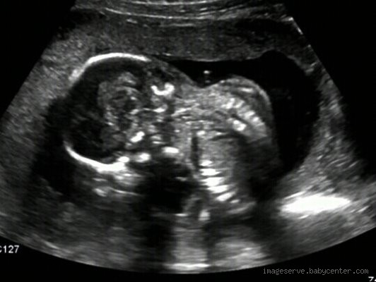 Can You Tell if Your Unborn Baby Has Down Syndrome?