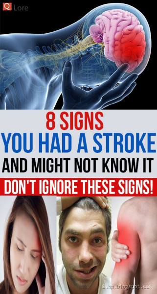 Did I Have a Stroke and Not Realize It? Here's What You Need to Know