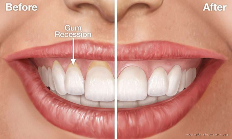 Do Receding Gums Go Back to Normal?