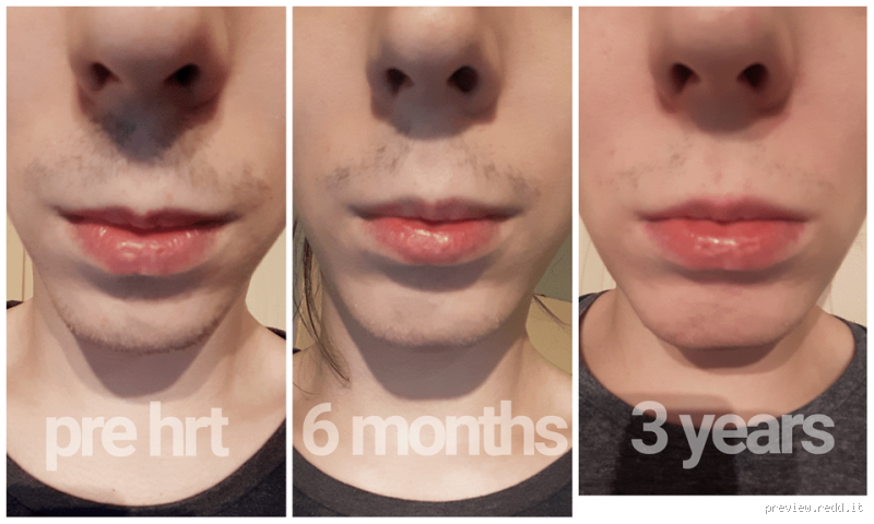 Does Estrogen Cause Facial Hair? Understanding the Connection