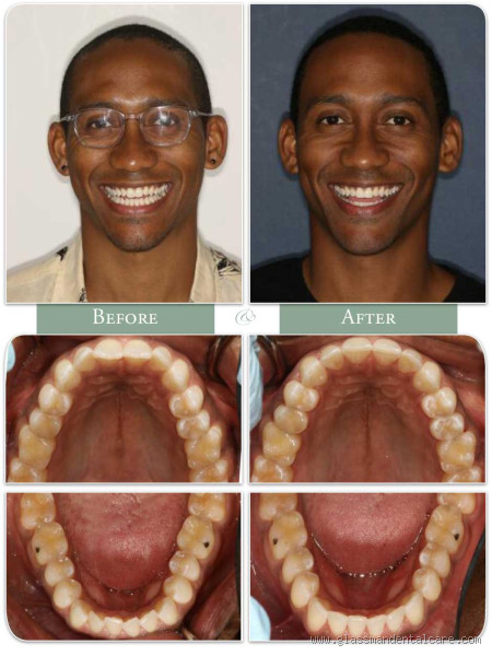 Does Invisalign Shift Your Jaw: Separating Fact from Fiction