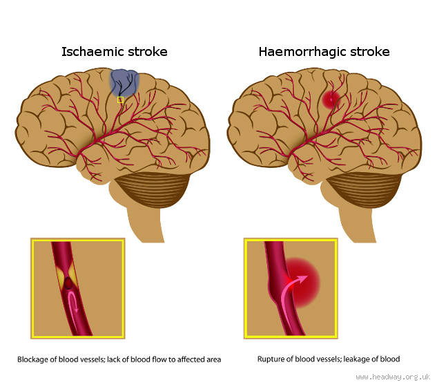 Does the brain continue to deteriorate after a stroke?