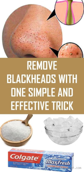 How to Get Rid of Blackheads Naturally? Discover Effective Solutions!