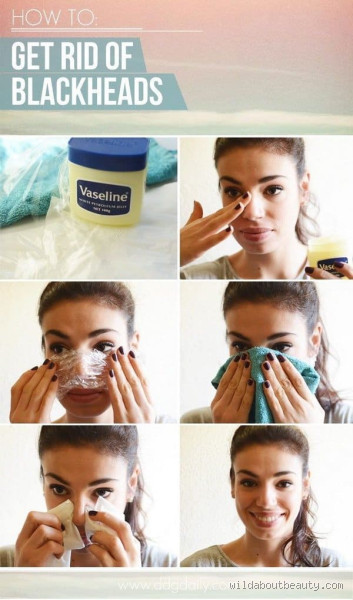 How to Get Rid of Blackheads Overnight at Home: Quick &amp; Easy Tips