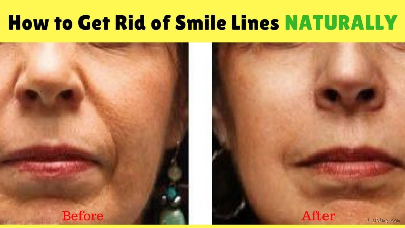 How to Get Rid of Deep Smile Lines at Home: Effective Remedies and Tips?