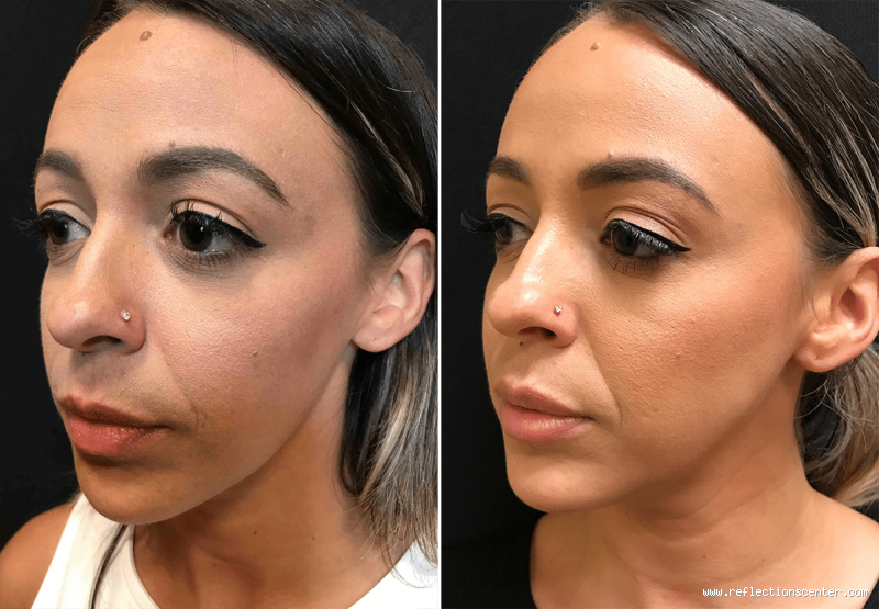 How Much Does One Syringe of Lip Filler Have? Find Out the Details