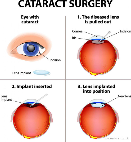 How Much Will Cataract Surgery Improve My Vision?