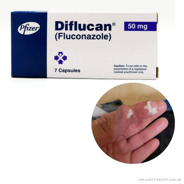 Is it Normal to Still Have Discharge After Taking Fluconazole?