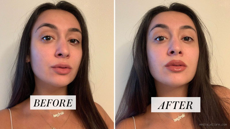 Is Your Top Lip Bigger Than the Bottom After Fillers: Causes and Solutions?