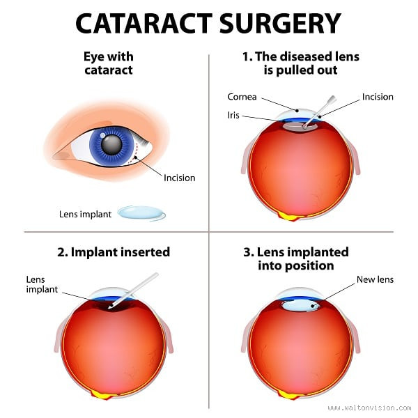 Should an 80-Year-Old Have Cataract Surgery? The Decision Explained