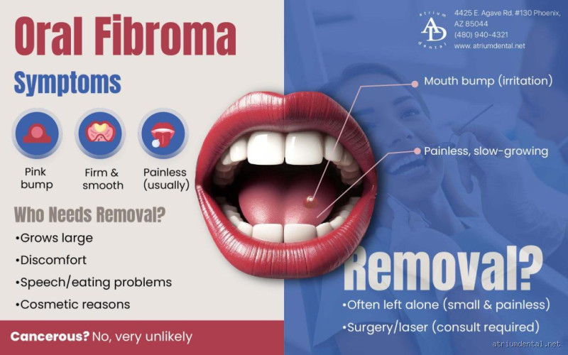 Should I Worry About an Oral Fibroma? Understanding the Risks