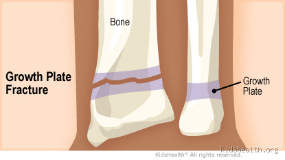 What Age Do Growth Plates Stop? Find Out When You Stop Growing