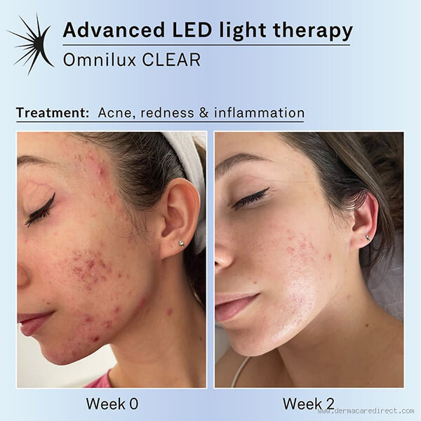 What Color LED Helps with Acne? A Guide to LED Light Therapy