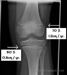 What Do Open Growth Plates Look Like? Here’s What You Need to Know