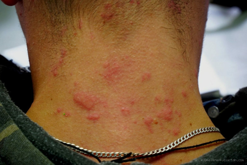 What Does Skin Look Like With Kidney Disease? Warning Signs You Should Know