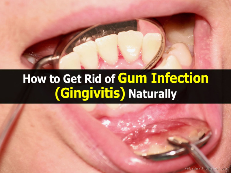 What is the Fastest Way to Get Rid of a Gum Infection?