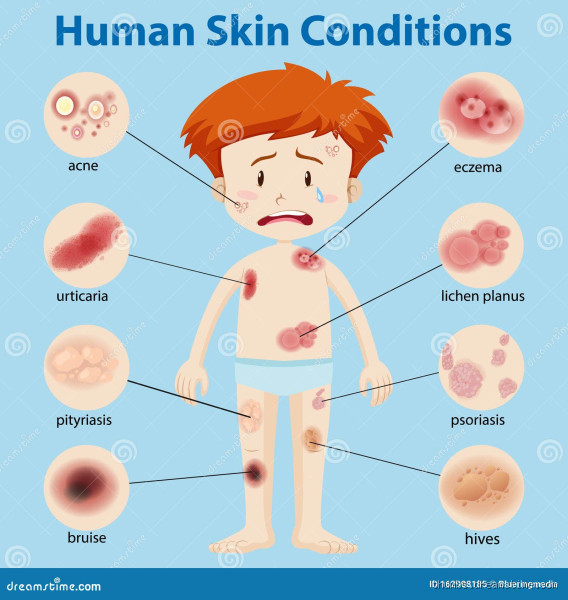 What Skin Condition is on Model? Understanding Common Conditions