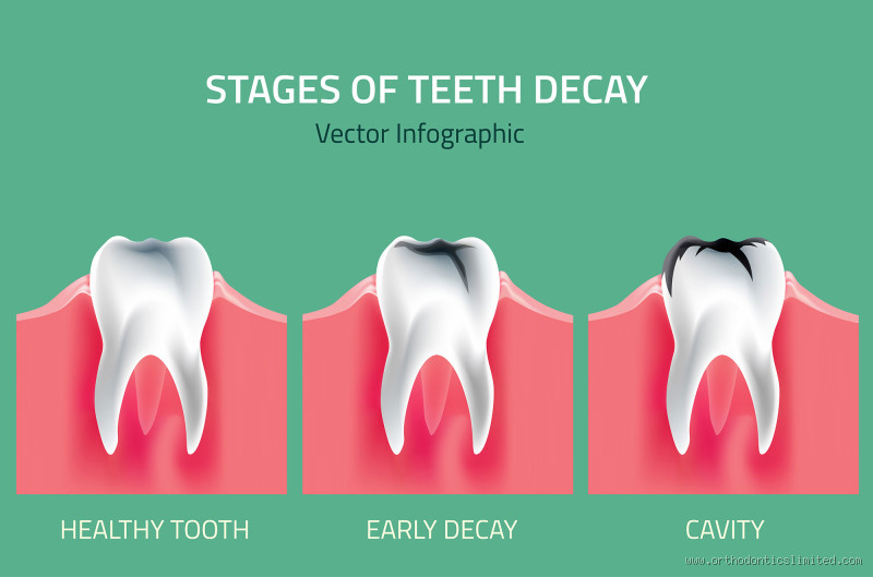 What to Do If All Teeth Are Decayed? A Step-by-Step Guide
