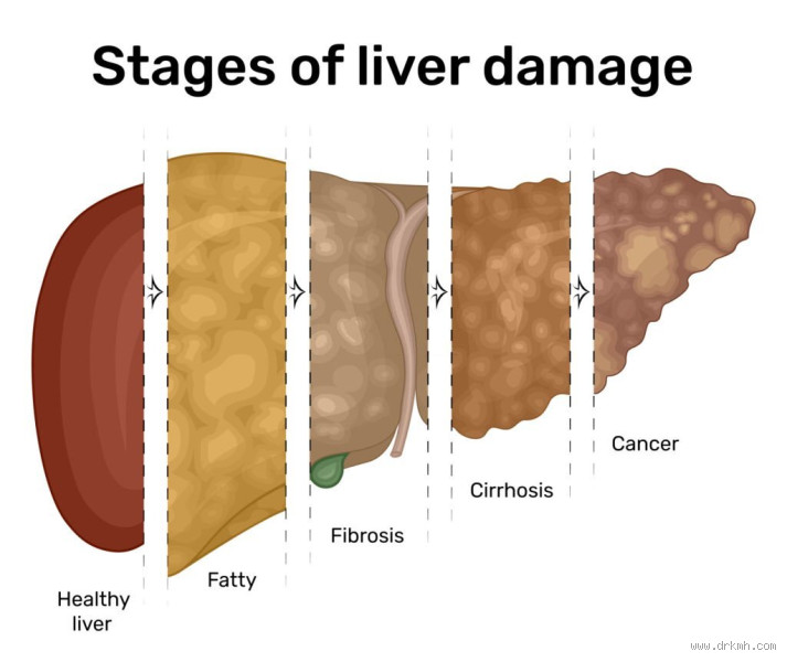 Fatty Liver Grade 1 vs Grade 2: Which is Worse for Your Health?