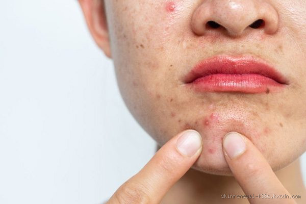 Which Skin Type Has Pimples? Uncover the Truth Behind Breakouts