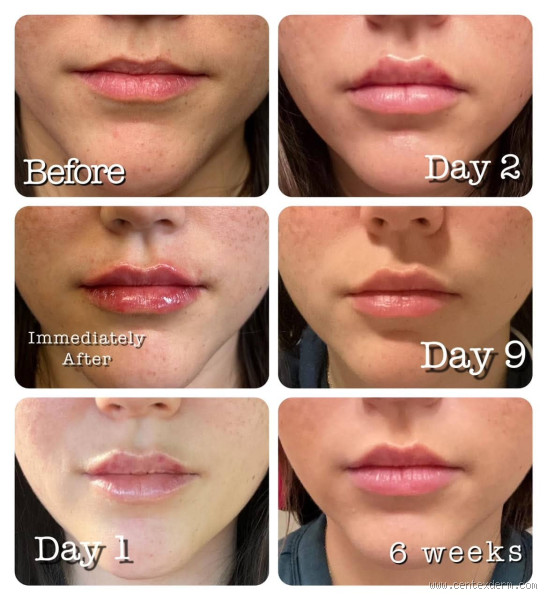 Why Do My Lips Look Ducky After Filler: Causes and Solutions for Uneven Lip Fillers