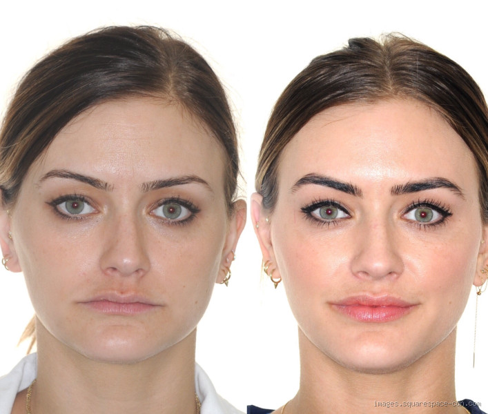 Why does my lip look bigger after Invisalign?