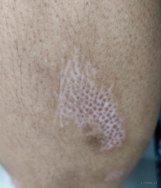 Why is There a Black Dot on My Scar? Uncovering the Mystery