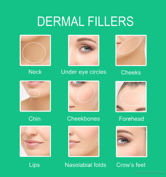 How Easy Is It for Filler to Move? A Deep Dive into Dermal Fillers