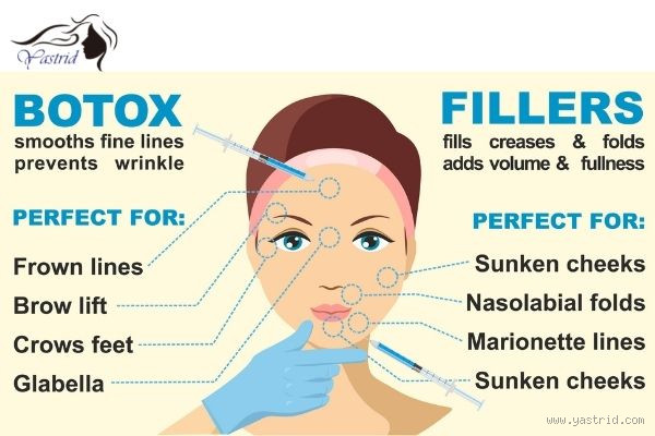 Is Botox or Fillers Better for Laugh Lines? A Detailed Comparison