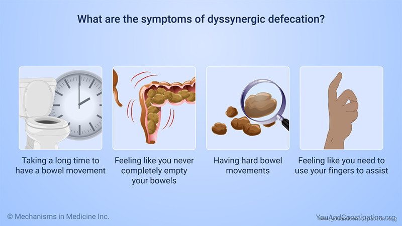 What is Dyssynergic Defecation? Causes, Symptoms, and Treatments